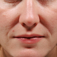 faltenunterspritzung, lippenvergrößerung, lippenaufbau, Lipolyse, hyaluronsäure