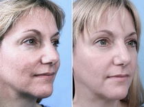 gesichtsbehandlung gesichtsreinigung gesicht behandlung reinigung lörrach basel steinen kosmetikstudio kosmetikerin kosmetik acne